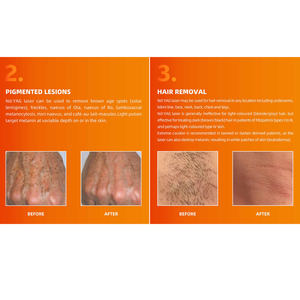 Mesin <span class=keywords><strong>Laser</strong></span> penghilang bulu, mesin <span class=keywords><strong>Laser</strong></span> penghilang bulu nd yag 1064nm - Product Image 5