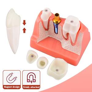 Modèle d'implant dentaire pour l'éducation des patients, modèle d'implant dentaire, <span class=keywords><strong>de</strong></span> couronne et <span class=keywords><strong>de</strong></span> pont <span class=keywords><strong>4</strong></span> fois plus grand pour la présentation - Rose - Product Image 4