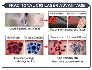 Dispositivo de Belleza 2025 Versión de Lujo, Tratamiento para el Acné con Dióxido de Carbono Indoloro de 1064nm, Rejuvenecimiento de la Piel, Cuidado Vaginal con CO2, para el Cuerpo en Casa - Product Image 5