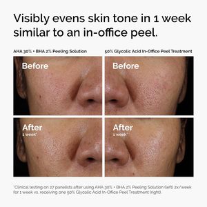Solución Exfoliante Facial de Marca Privada con <span class=keywords><strong>AHA</strong></span> <span class=keywords><strong>30</strong></span>% + BHA 2%, Exfoliante Avanzado para una Piel Más Brillante - Product Image 6