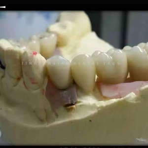 กล้องส่องทางไกลแบบครอบฟันรองรับฟันปลอม ivoclavar scheftner ผลิตตามสั่งไทเทเนียมห้องปฏิบัติการทันตกรรมจีน - Product Image 4