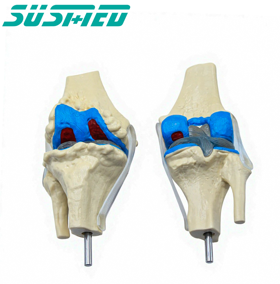 4 Stage Osteoarthritis Knee Model, Human Joint Anatomical Model ...