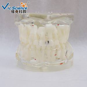 Modelo <span class=keywords><strong>Dental</strong></span> de Patología Educativa en Oferta, Modelo de Dientes Patológicos Semi-Laterales - Product Image 2