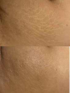Portátil 60W Marcas Eliminación de pigmentos Estiramiento facial CO2 Láser fraccional Co2 Láser fraccional vaginal - Product Image 4