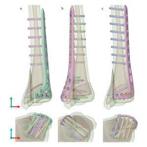 Implantes Ortopédicos Quirúrgicos Manuales de Titanio para Tibia Distal, con Bloqueo Intramedular Multidimensional, Eficaz para Traumatismos - Product Image 1