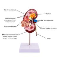 Modelo de Riñón Patológico y Normal - Simulación de Enseñanza de Urología, Modelo de Anatomía y Estructura del Riñón Humano