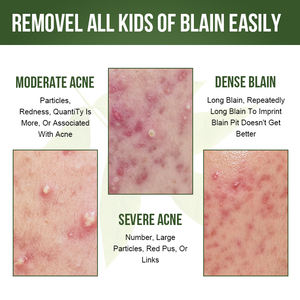 Cosmetici Coreani Crema per Acne Controllo Sebo Rimuovi Brufoli e Cicatrici da Acne Crema Viso al Tea Tree Crema Viso alle Erbe Estratto di Erbe - Product Image 2