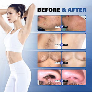 Máquina de Depilación Láser de Diodo de 808nm de Alta Potencia con Triple Longitud de Onda y 2 Manípulos para Rejuvenecimiento de la Piel - Product Image 6