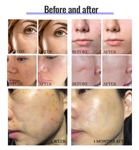 Máquina de Plasma Profesional de Alta Calidad para Eliminar Poros y Limpiar la Piel, con Dos Manijas, para Spa de Belleza - Product Image 6