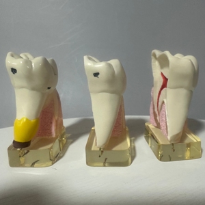 Nha khoa Răng mô hình PVC manikin cho giảng dạy hàm răng giả phân rã & sâu răng quá trình trong y tế khoa học - Product Image 3