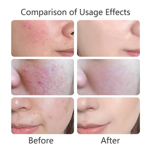 <span class=keywords><strong>เซ</strong></span><span class=keywords><strong>รั่</strong></span><span class=keywords><strong>ม</strong></span>ต่อต้านสิวออร์แกนิกที่ทำให้แผลเป็นจากสิวช่วยฟื้นฟูผิวและทำให้ผิวกระจ่างใส - Product Image 5