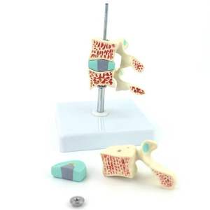 Osteoporose-Knochen modell-Zeigen Sie die normale/Osteopenie/osteoporo tische Knochen dichte mit abnehmbarem Wirbel - Product Image 4