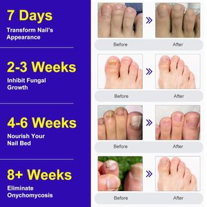 Patchs multifonctionnels en hydrogel pour soins des ongles, patchs pour ongles atteints d'onychomycose, patchs pour soins des ongles, patchs pour les rainures des ongles - Product Image 4
