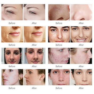 Máquina láser fraccional de CO2 portátil de 10,6 μm y 60W, longitudes de onda de 10600nm para rejuvenecimiento de la piel, eliminación de cicatrices de acné - Product Image 6