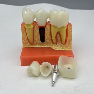 Medische Wetenschappelijke Lesapparatuur Leermodellen Tandheelkundige Typodont Menselijke Tanden Modelpraktijk Tandheelkundig Implantaatmodel - Product Image 6