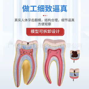 Molares ampliados 3 veces, patología dental completa, dientes transparentes, caries dentales, enseñanza de comunicación con pacientes dentales - Product Image 2