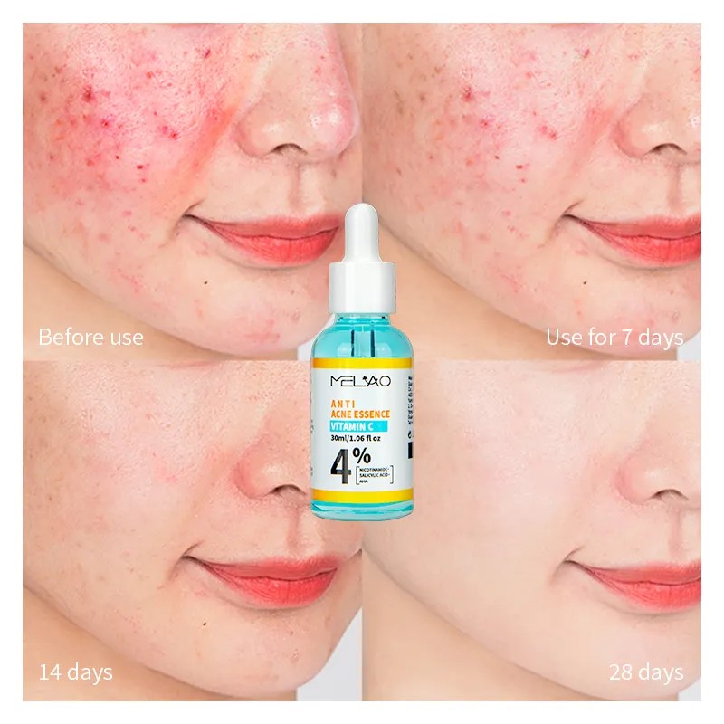 Siero viso Anti Acne rimozione Acne brufolo riparazione siero trattamento Acne con vitamina C acido salicilico Niacinamide