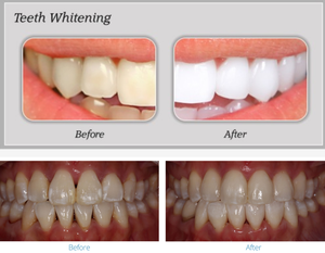 Mesin operasi tisu lembut pemotong Oral <span class=keywords><strong>Laser</strong></span> Diode 980nm 1470nm peralatan <span class=keywords><strong>Laser</strong></span> Gigi medis untuk gingivektomi - Product Image 4