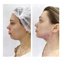 Mesin Lipolisis Mini Invasif 2026 Diode Laser 980nm+1470nm Vaser Liposuction Endo Diodo Laser Lifting