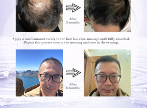Essence de soin du cuir chevelu pour les porteurs de perruques de cheveux humains-Réduit l'amincissement des cheveux et hydrate le cuir chevelu avec extrait de plantes - Product Image 5