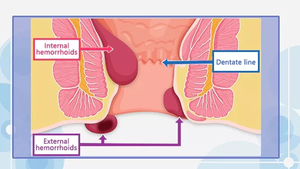 Tratamiento con láser de diodo para cirugía clínica hospitalaria, 2023 + 1470nm, proctología, hemorroides, Anal, 980nm - Product Image 5