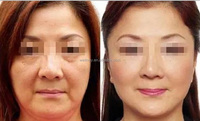 Vente flash - Appareil de mésothérapie sans aiguille portable pour salon de beauté, clinique, resserrement de la peau, électroporation, machine de mésothérapie