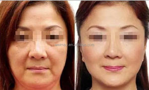 핫 세일 휴대용 스파 살롱 클리닉 사용 바늘 메조 테라피 장치 피부 강화 Electroporation 메조 테라피 기계 - Product Image 5