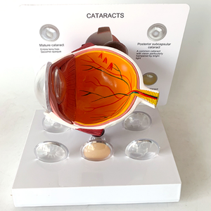 Modelo <span class=keywords><strong>de</strong></span> ojos para mostrar la ciencia médica, patología humana, para educación - Product Image 4