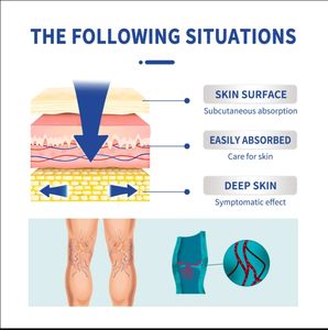 Pomada 100% Original para Varizes e Vasculite, Alívio da Dor nas Pernas e Remoção de Vasculite - Product Image 5