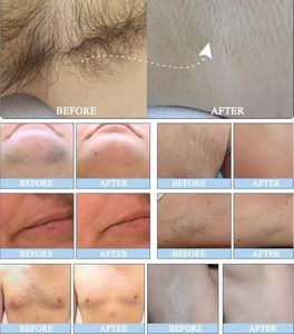 Portable Permanent Hair Removal 808nm Laser Machine Ice Painless Single-handle diode laser Skin Rejuvenation for Beauty Salon - Product Image 6