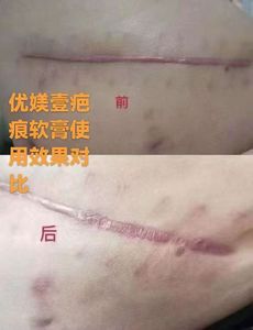 Crema Reparadora de Cicatrices con Fórmula Personalizada de Vidrio Bioactivo, Tratamiento para Marcas de Estrías del Embarazo, 20g, Cicatrices de Cesárea - Product Image 4