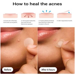 Parches <span class=keywords><strong>de</strong></span> espinillas para la <span class=keywords><strong>cara</strong></span> 5 colores y 5 tamaños (8,10,12,14,16mm) Parches para el acné Hidrocoloide Cute Star Spot Stickers con árbol <span class=keywords><strong>de</strong></span> té - Product Image 3