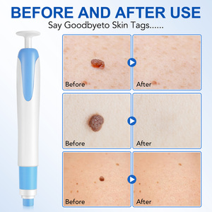 Wholesale 4-9mm Large <strong>Skin</strong> <strong>Tags</strong> <strong>Removal</strong> Kit Safe Fast Easy <strong>Skin</strong> <strong>Tag</strong> Remover Pen for Face Body with <strong>Skin</strong> Repair <strong>Patches</strong> - Product Image 4