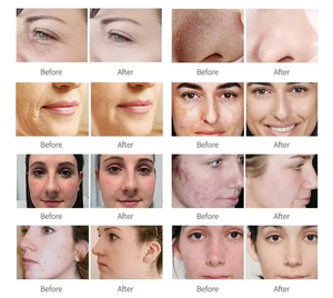 Máquina de Belleza para Rejuvenecimiento Facial y Renovación de la Piel con Tecnología Fraccional, para una Curación Más Rápida - Product Image 4