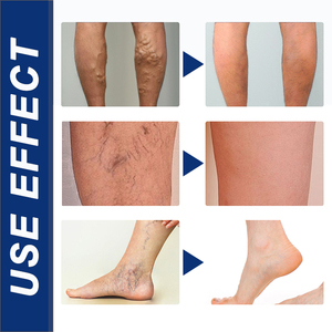 Miao Sanshu, <span class=keywords><strong>crema</strong></span> reparadora de venas del muslo, Gel de compresa fría <span class=keywords><strong>para</strong></span> venas varicosas, OEM, una pieza, venta al por mayor - Product Image 5