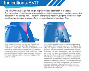 Dispositivo de ablación láser endovenosa Evlt de 980nm y 1470nm para la eliminación de venas varicosas - Product Image 6