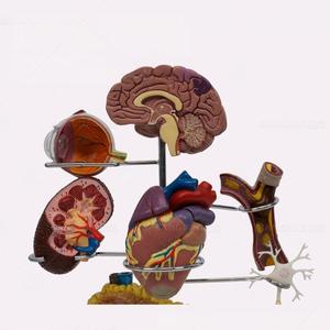 Modelo de Enseñanza Médica, Modelo de Diabetes para Educación en Endocrinología y Fisiopatología - Product Image 3