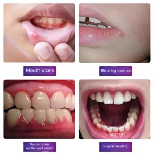 Venta al por mayor nueva úlcera oral bastoncillo de algodón líquido a base de hierbas integrado para alivio rápido del dolor <span class=keywords><strong>boca</strong></span> nasal y parches corporales - Product Image 4