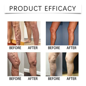 Crème pour les veines à la marron d'Inde South Moon, soulage les varices, améliore la circulation sanguine, hydrate la peau des <span class=keywords><strong>jambes</strong></span>, 30g - Product Image 5