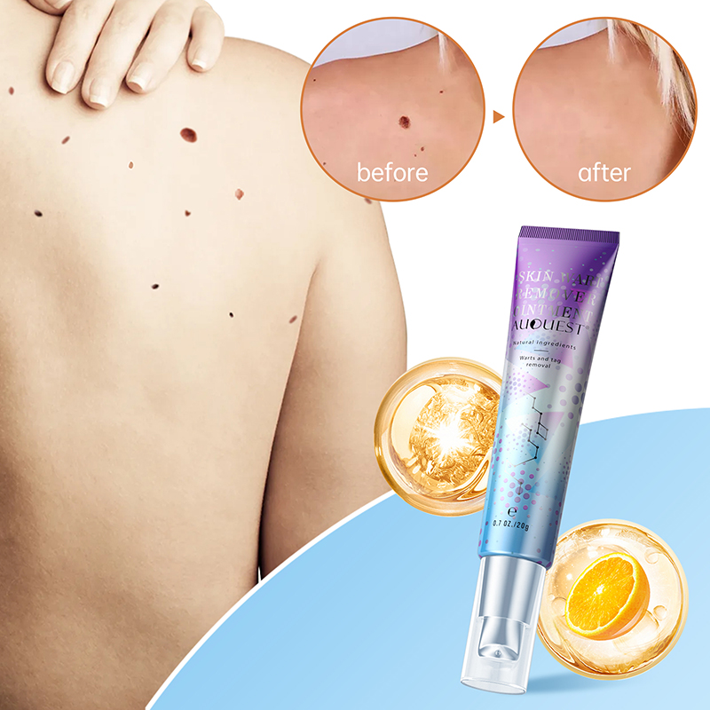 Herbal Wart Skin Removal Ointment Painless Warts Treatment Cream Medical Plaster Body Care
