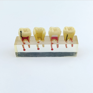 Modello Didattico Dentale Trasparente per Pratica Radicolare, Modello di Denti con Malattie per Studio e Trattamento Endodontico - Product Image 2