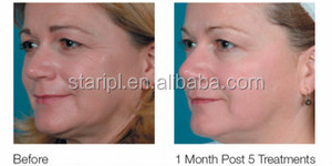 Appareil d'épilation IPL 3-en-1 True Love sans douleur à glissière pour usage professionnel en salon, rajeunissement de la peau, traitement des cicatrices avec refroidissement par <span class=keywords><strong>eau</strong></span> et air - Product Image 3