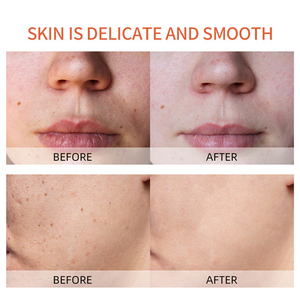 Ensemble de soins de la peau personnalisable OEM, naturel, biologique, à base de vitamine C, d'acide kojique et de curcuma, anti-rides, éclaircissant, réducteur de taches brunes et d'acné - Product Image 6