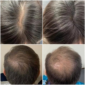 Pulvérisateur de poudre pour fibres épaississantes pour cheveux, pour couvrir la calvitie et densifier la ligne des cheveux, noir, ABS, silicone, unisexe - Product Image 5