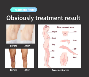 Klinik pintar panas medis 1800W 3000W dioda laser es <span class=keywords><strong>platinum</strong></span> 755 808 1064 titanium laser pemotong rambut mesin - Product Image 6