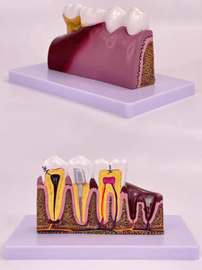 Modèle de caries dentaires pathologiques, modèle pédagogique complet de pathologie dentaire, modèle anatomique du dôme dentaire - Product Image 5