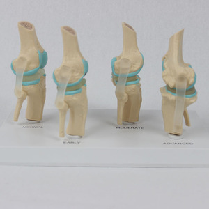 Modèle de genou articulé malade à 4 étapes - Le fabricant fournit des équipements pédagogiques médicaux - Product Image 3