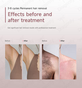 Équipement de beauté laser Dream Plus Salon 1600W 2025 Nouvelle <span class=keywords><strong>analyse</strong></span> de la peau par IA Laser diode Filtre à eau Épilation 755 808 1064nm UE - Product Image 2