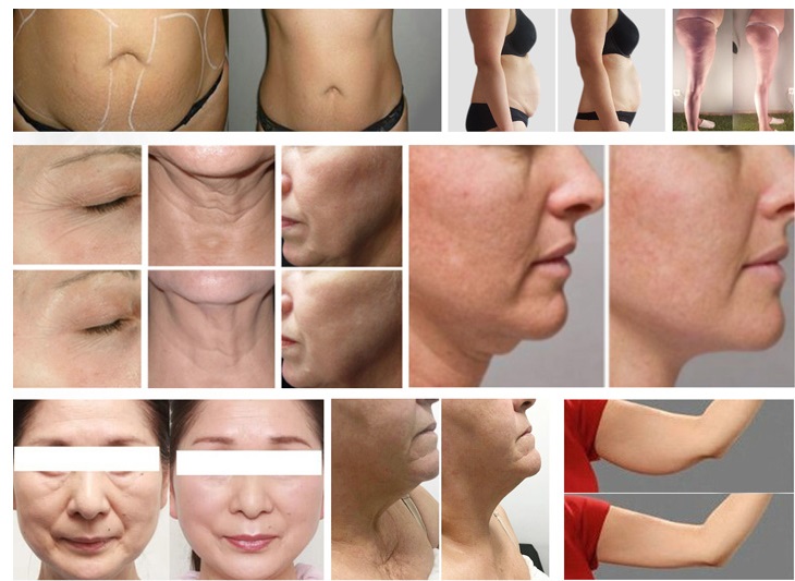 2021 Bag-ong Pag-abot sa Lipo Laser Cavitation slimming Machine lipo slim laser rf vacuum cavitation