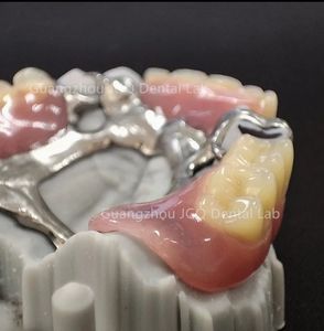 กรอบโลหะฟันปลอมบางส่วนที่ถอดออกได้ได้รับความนิยมมีความเสถียรและการเก็บรักษา (โคบอลต์และโครเมี่ยม) - Product Image 2